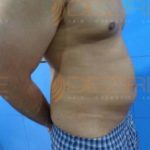 Full Body Fat Removal Surgery Effect in Pune