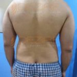 Full Body Fat Removal Surgery Pune