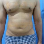 Full Body Fat Removal Surgery in Pune