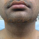 How Does Liposuction Work in Dezire Clinic