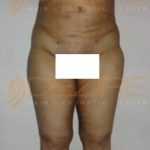 Ice Sculpting Fat Removal Before After in Pune