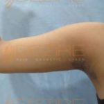 Laser Arm Fat Removal Women Pune