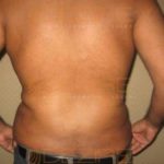 Laser Assisted Liposuction Low Cost Pune