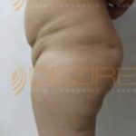 Laser Assisted Liposuction in Pune