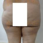 Laser Assisted Liposuction in Pune India