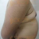 Laser Assisted Liposuction in Pune World