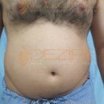 Laser Fat Removal Results in India