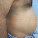 Laser Fat Removal Results in Pune