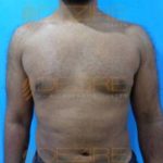 Laser Fat Removal Without Surgery Before After Photo Pune