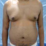 Laser Fat Removal Without Surgery in Pune India