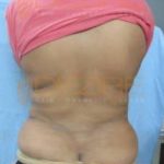 Laser Stomach Fat Removal Before After Photo Pune