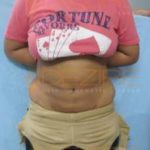 Laser Stomach Fat Removal Best Price in Pune