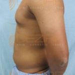 Laser Stomach Fat Removal Cost in Pune