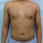 Laser Stomach Fat Removal Cost in Pune India