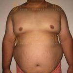Laser Treatment For Fat Removal in Pune