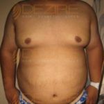 Laser Weight Loss Surgery Cost Images