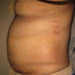 Laser Weight Loss Surgery Rupees
