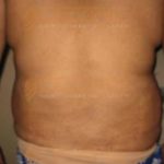 Laser Weight Loss Surgery Safe Cost