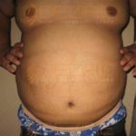 Laser Weight Loss Surgery Safe or not