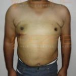 Latest Fat Reduction Treatments After 1 weeks Pune