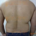 Latest Fat Reduction Treatments Before After Images Pune