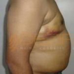 Latest Fat Reduction Treatments Days Pune