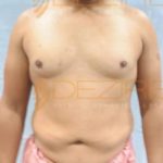 Latest Fat Reduction Treatments Low Cost in Pune