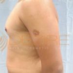 Latest Fat Reduction Treatments Pune