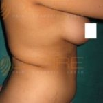 Latest Fat Reduction Treatments in Pune