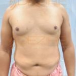 Latest Fat Reduction Treatments in Pune