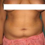 Latest Fat Reduction Treatments in Pune India