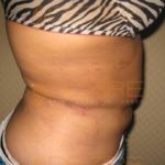 Latest Fat Reduction Treatments in Safe Or Not Pune