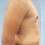 Latest Fat Reduction Treatments side Effect in Pune