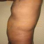Leg Fat Removal Surgery Low Cost in Pune