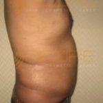 Leg Fat Removal Surgery Permanent in Pune