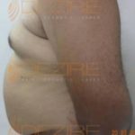 Liposuction Alternative Pune
