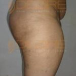 Liposuction Alternative in Pune