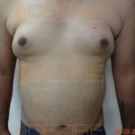 Liposuction Alternative in Pune India