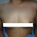 Liposuction Alternative in Pune World