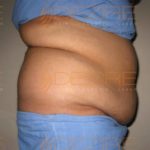 Liposuction Without Surgery low Cost