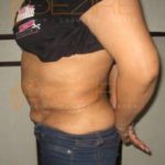 New Fat Reduction Treatments Pune