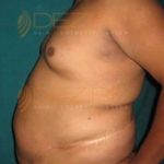 New Fat Removal Without Surgery Average Cost