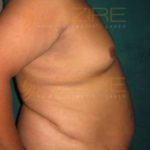 New Fat Removal Without Surgery Cost in Pune