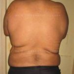 New Fat Removal Without Surgery Result in Pune