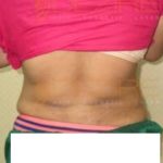 Newest Liposuction Procedures Before After Photo in Pune