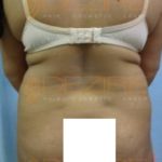 Newest Liposuction Procedures Low Cost in Pune