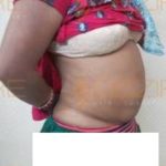 Newest Liposuction Procedures Safe Or Not in Pune