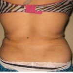 Newest Liposuction Procedures Side Effect