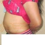 Newest Liposuction Procedures in Pune