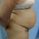 Newest Liposuction Procedures in Pune World